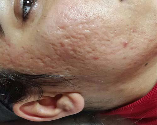 Akneli Cilt Bakımı