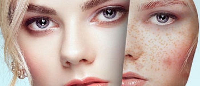 Leke Bakımı Elazığ